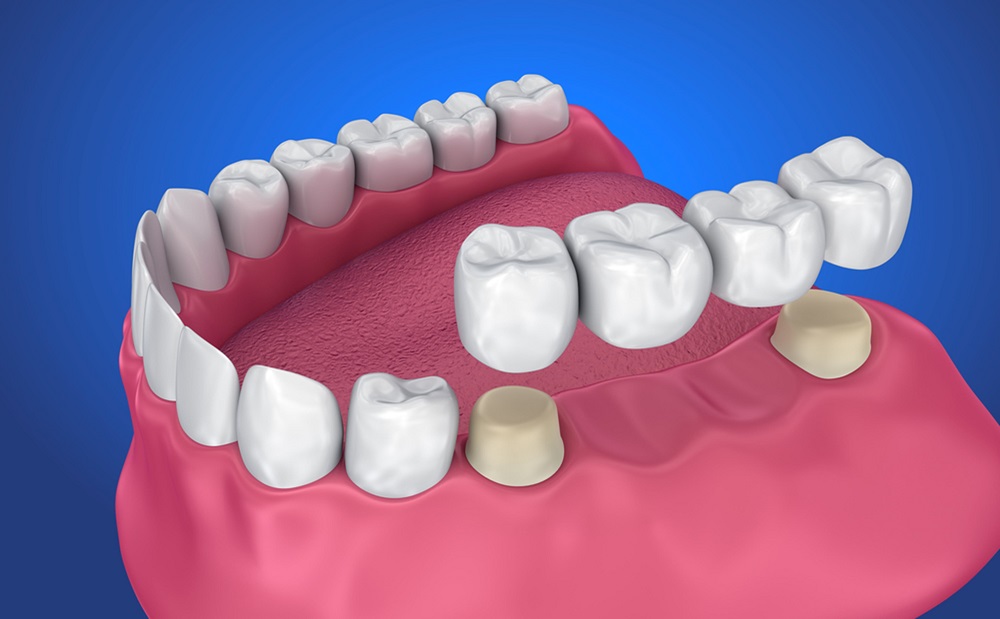 the benefits of getting fitted for dental bridges and dental crowns