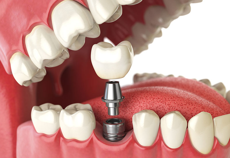 dental implants in malton