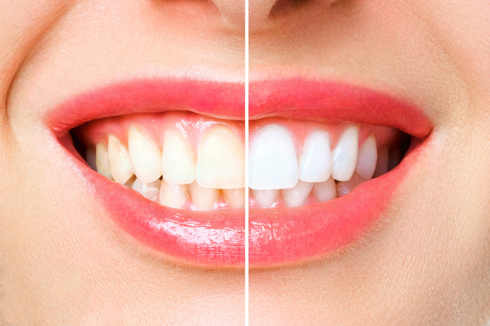 The Risks Of At-Home Teeth Whitening